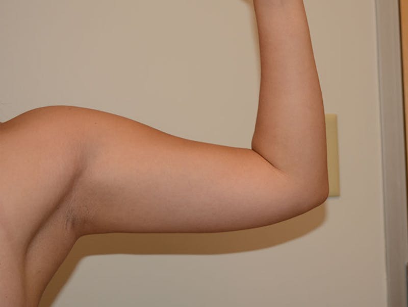 Arm Liposuction Before & After Gallery - Patient 12861710 - Image 1