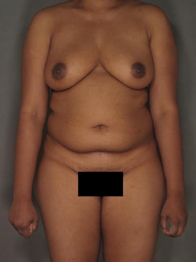 Liposuction Before & After Gallery - Patient 12880226 - Image 1