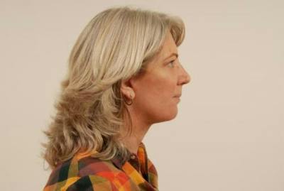 Facelift/Necklift Before & After Gallery - Patient 12861709 - Image 2