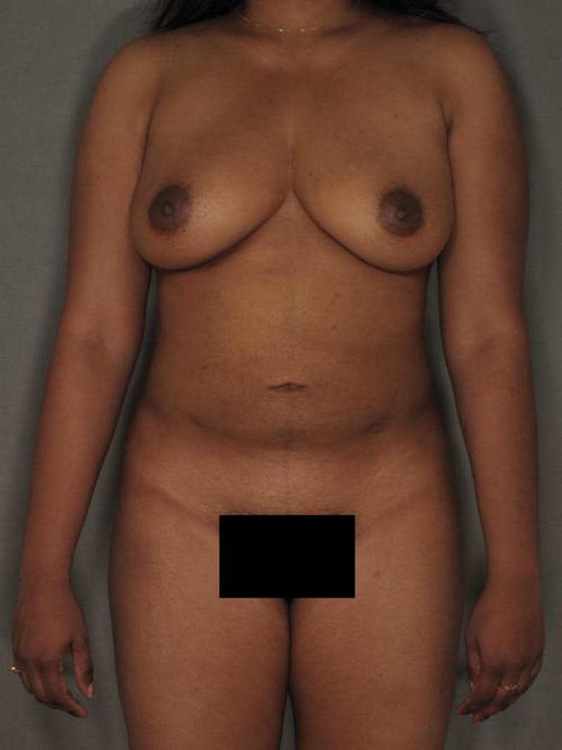 Liposuction Gallery - Patient 12880226 - Image 2