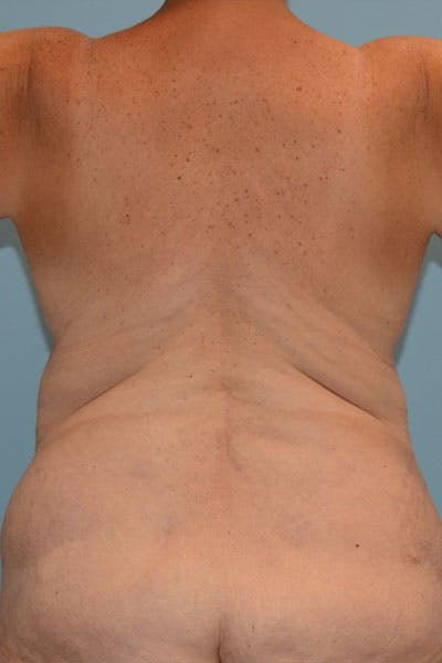 Lower Body Lift Before & After Gallery - Patient 12861711 - Image 1