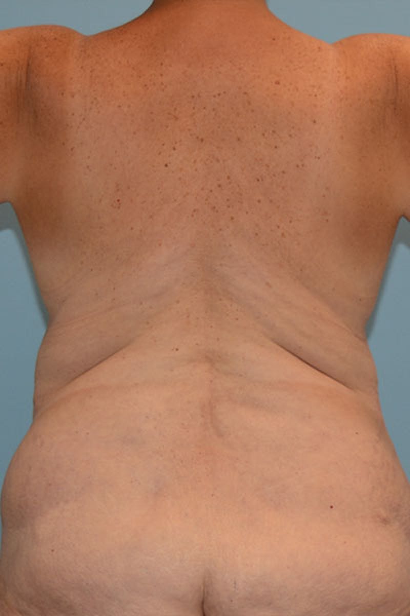 Lower Body Lift Before & After Gallery - Patient 12861711 - Image 1