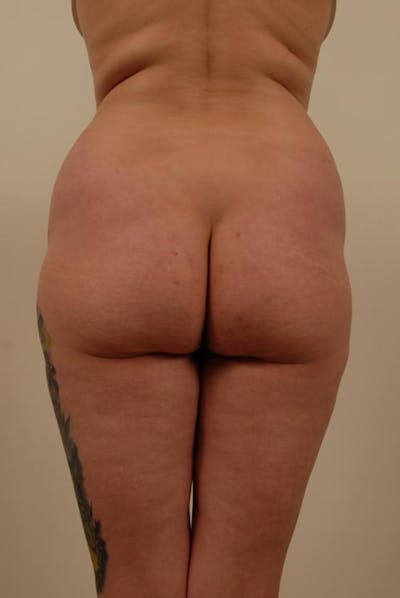 Brazilian Butt Lift Before & After Gallery - Patient 12880227 - Image 1