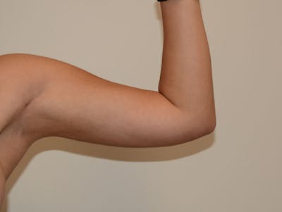 Arm Liposuction Before & After Gallery - Patient 12861710 - Image 2