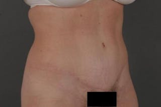 Tummy Tuck Before & After Gallery - Patient 12880228 - Image 4