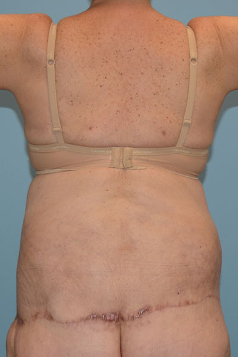 Lower Body Lift Before & After Gallery - Patient 12861711 - Image 2