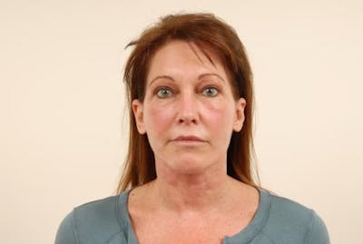 Facelift/Necklift Before & After Gallery - Patient 12880236 - Image 2