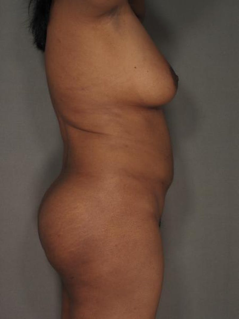 Liposuction Before & After Gallery - Patient 12880226 - Image 4