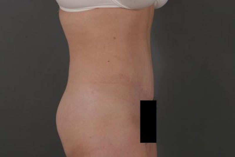 Tummy Tuck Before & After Gallery - Patient 12880228 - Image 6