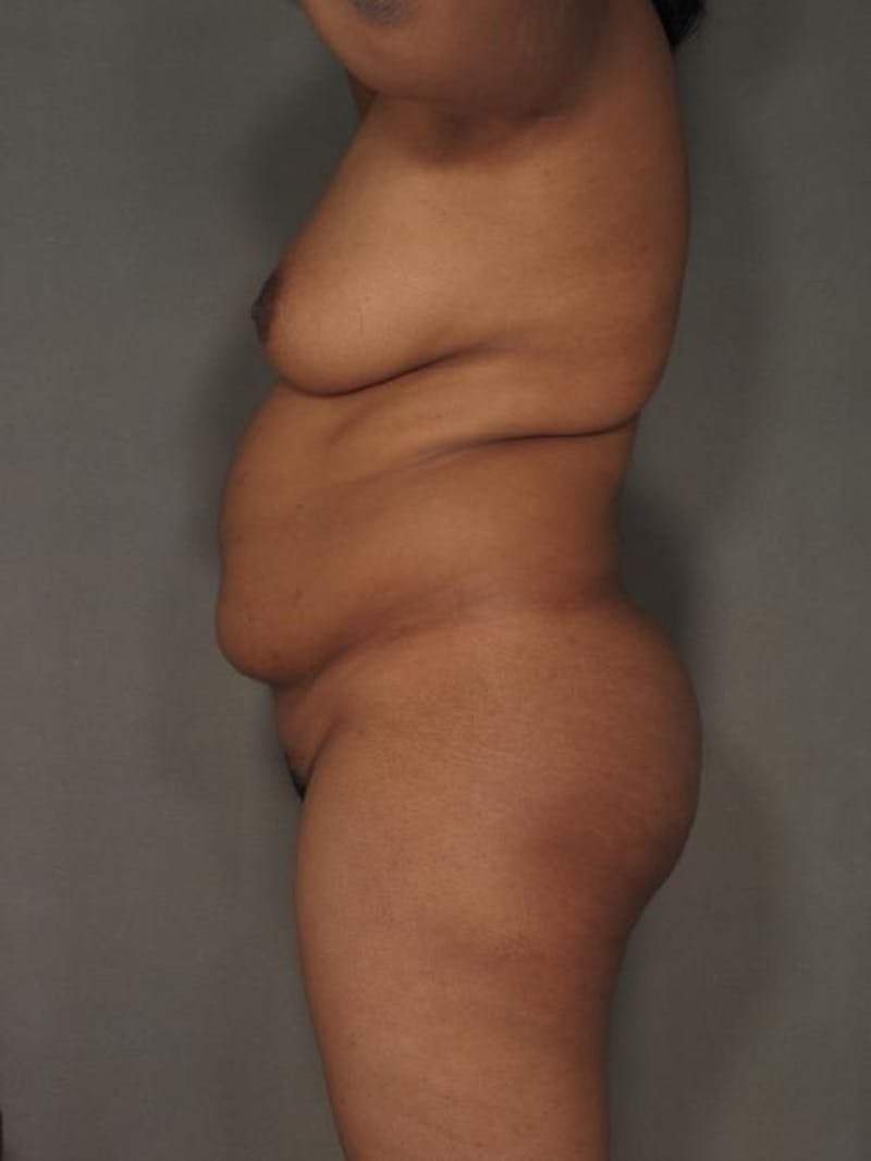 Liposuction Before & After Gallery - Patient 12880226 - Image 5