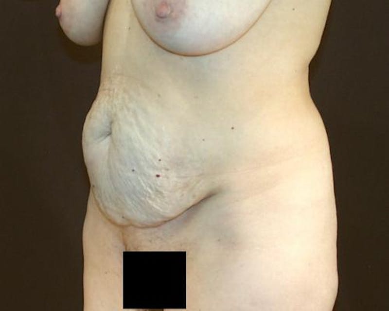 Tummy Tuck Before & After Gallery - Patient 12880228 - Image 7