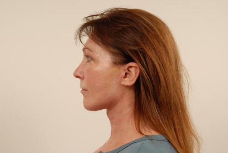 Facelift/Necklift Before & After Gallery - Patient 12880236 - Image 4