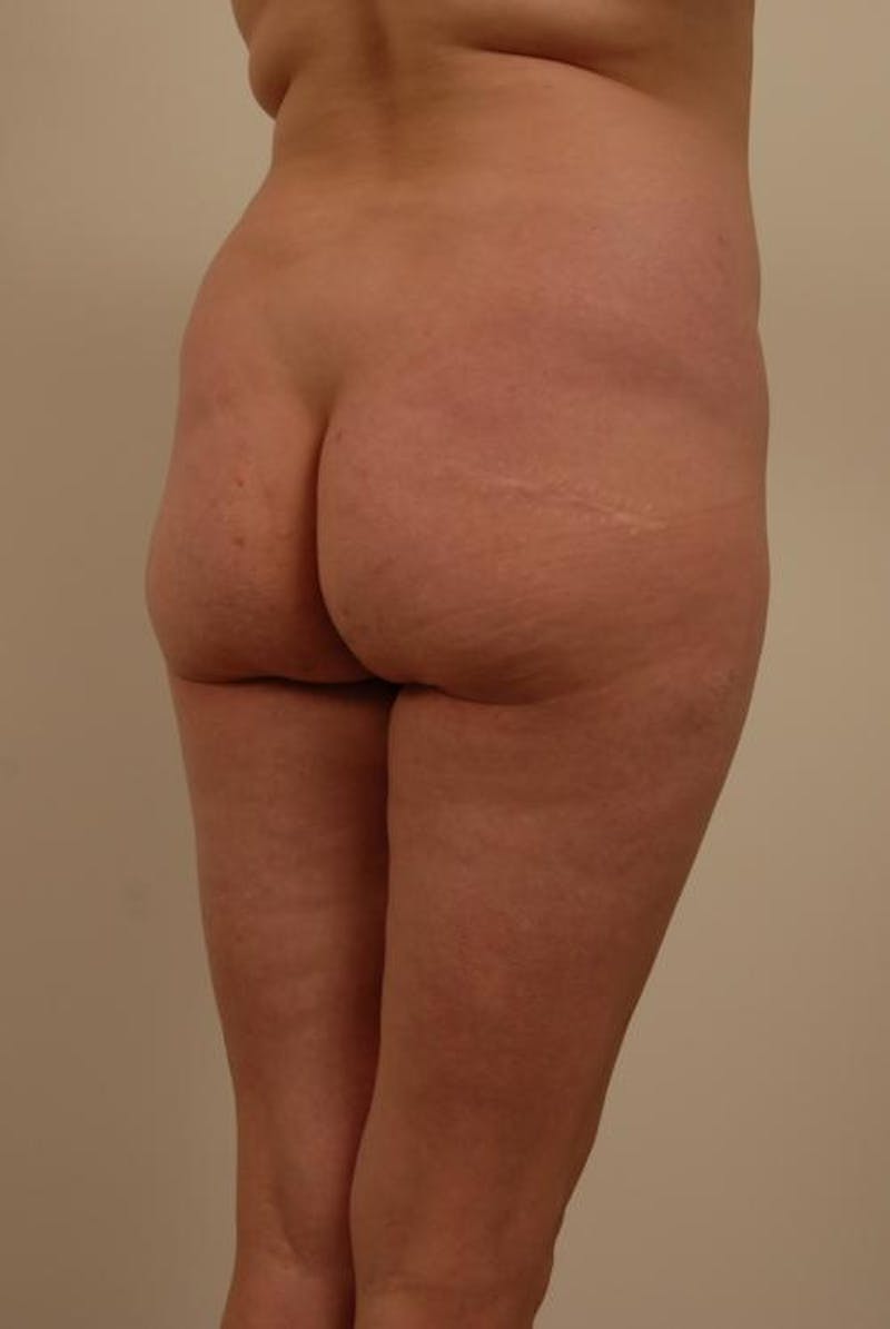 Brazilian Butt Lift Gallery - Patient 12880227 - Image 5