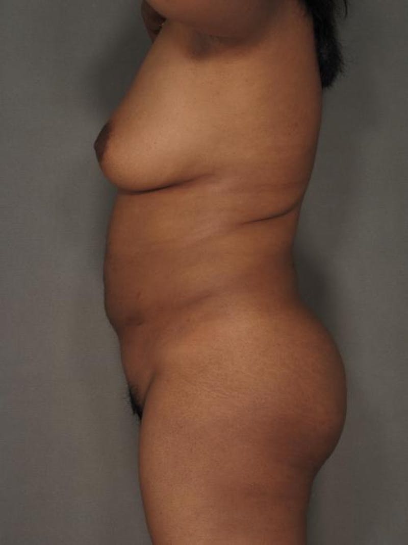 Liposuction Before & After Gallery - Patient 12880226 - Image 6