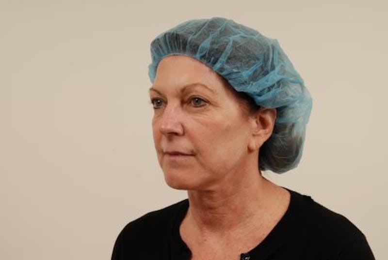Facelift/Necklift Before & After Gallery - Patient 12880236 - Image 5