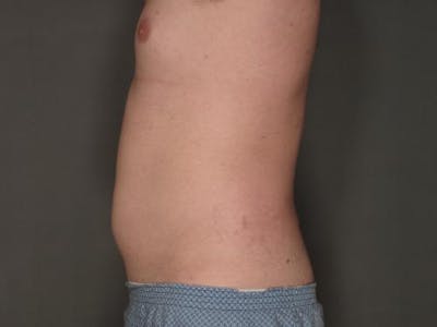 Liposuction Before & After Gallery - Patient 12880237 - Image 1
