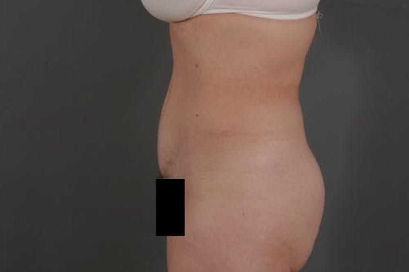 Tummy Tuck Before & After Gallery - Patient 12880228 - Image 9