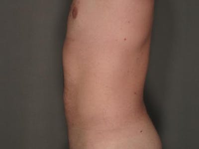Liposuction Before & After Gallery - Patient 12880237 - Image 2