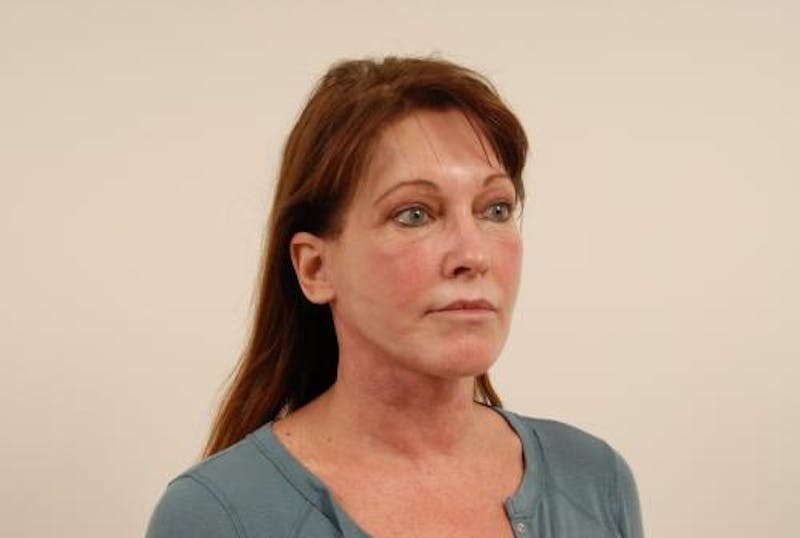Facelift/Necklift Before & After Gallery - Patient 12880236 - Image 8
