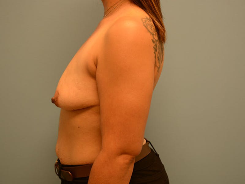 Breast Lift Before & After Gallery - Patient 12880235 - Image 5