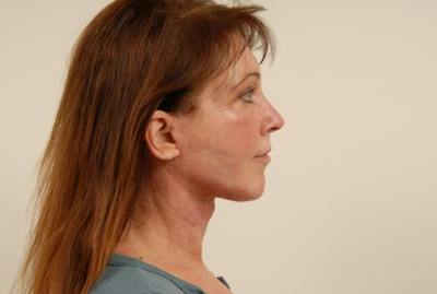Facelift/Necklift Before & After Gallery - Patient 12880236 - Image 2