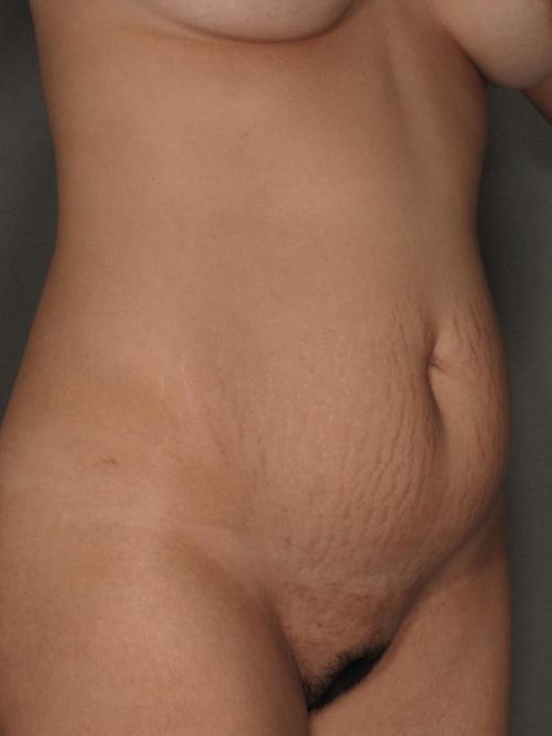 Tummy Tuck Before & After Gallery - Patient 12880239 - Image 3