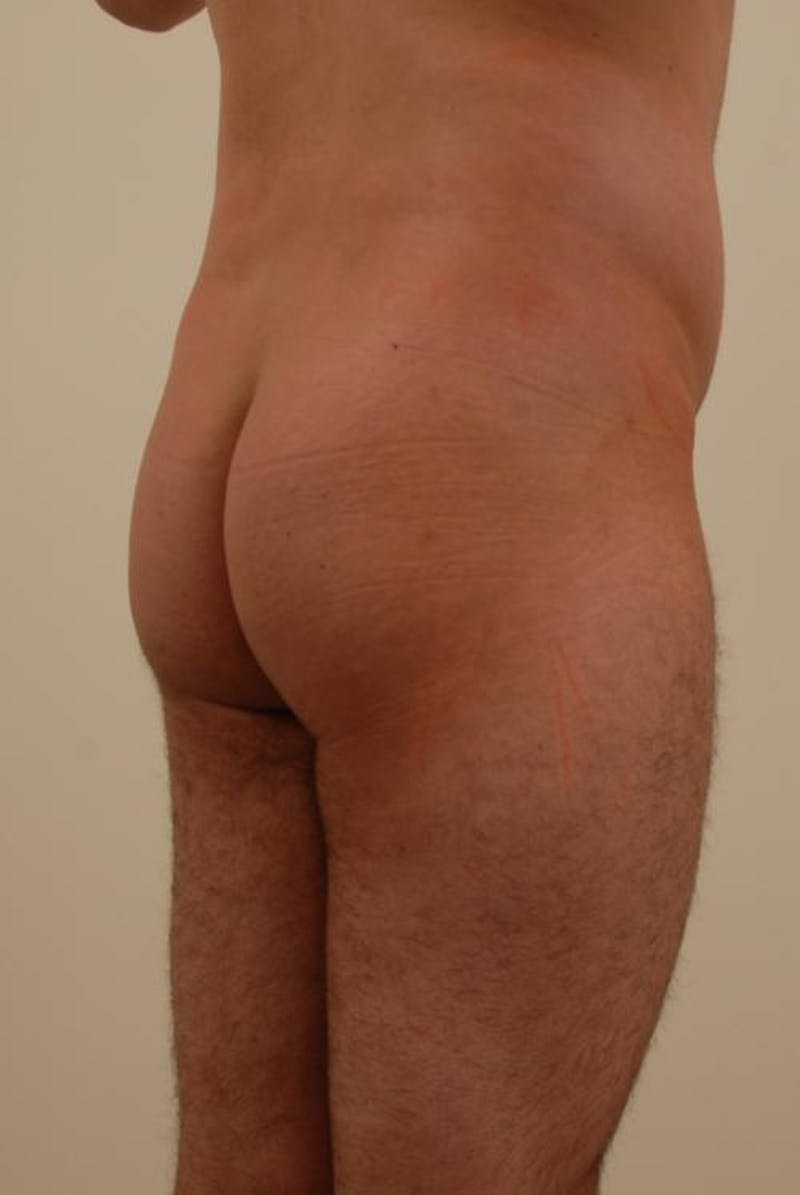 Brazilian Butt Lift Before & After Gallery - Patient 12880241 - Image 1