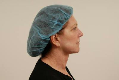 Facelift/Necklift Before & After Gallery - Patient 12880236 - Image 1