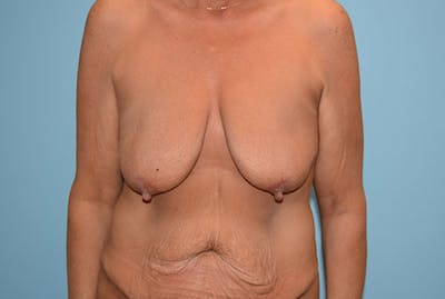 Breast Lift Before & After Gallery - Patient 12880240 - Image 1