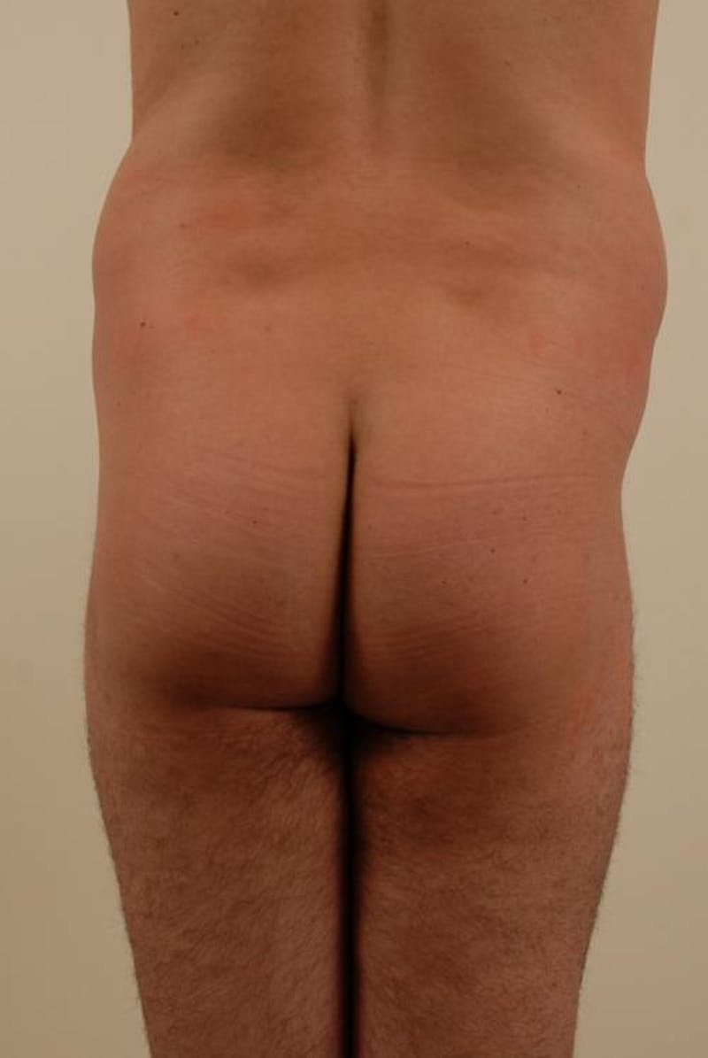Brazilian Butt Lift Gallery - Patient 12880241 - Image 3