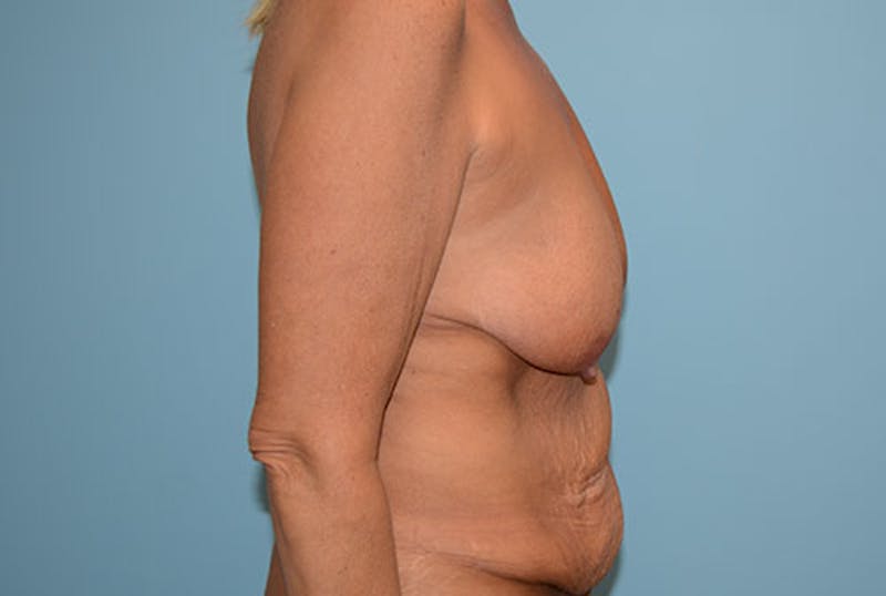 Breast Lift Before & After Gallery - Patient 12880240 - Image 3