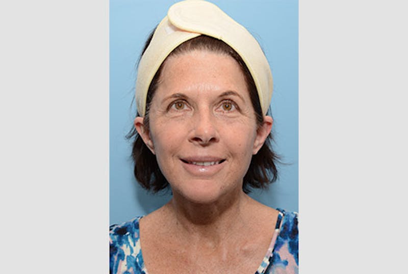 Facelift/Necklift Before & After Gallery - Patient 12880244 - Image 2