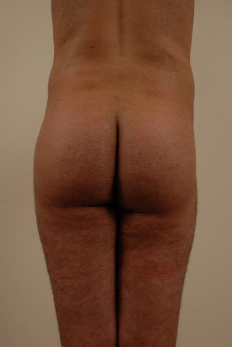 Brazilian Butt Lift Before & After Gallery - Patient 12880241 - Image 4