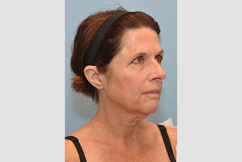 Facelift/Necklift Before & After Gallery - Patient 12880244 - Image 3