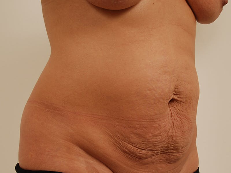 Mommy Makeover Before & After Gallery - Patient 12880250 - Image 13