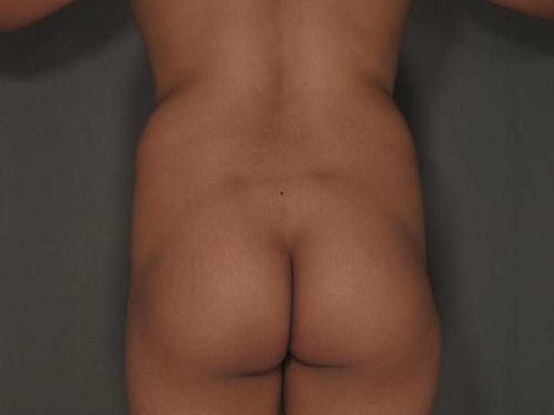 Liposuction Gallery - Patient 12880242 - Image 3