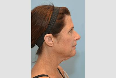 Facelift/Necklift Before & After Gallery - Patient 12880244 - Image 1