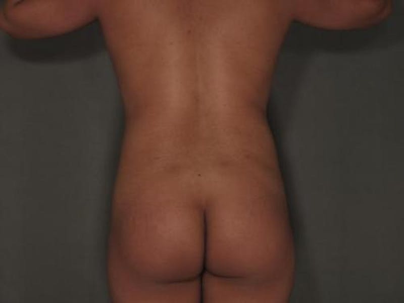 Liposuction Gallery - Patient 12880242 - Image 4