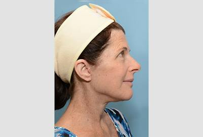 Facelift/Necklift Before & After Gallery - Patient 12880244 - Image 2