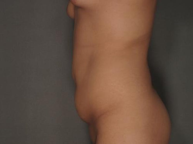 Tummy Tuck Before & After Gallery - Patient 12880255 - Image 3