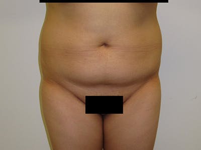 Liposuction Before & After Gallery - Patient 12880245 - Image 1