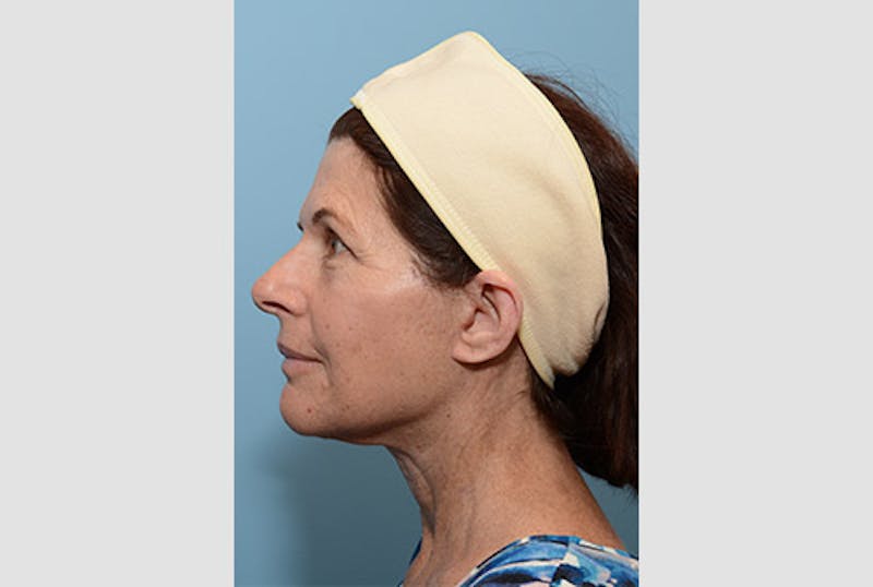 Facelift/Necklift Before & After Gallery - Patient 12880244 - Image 8
