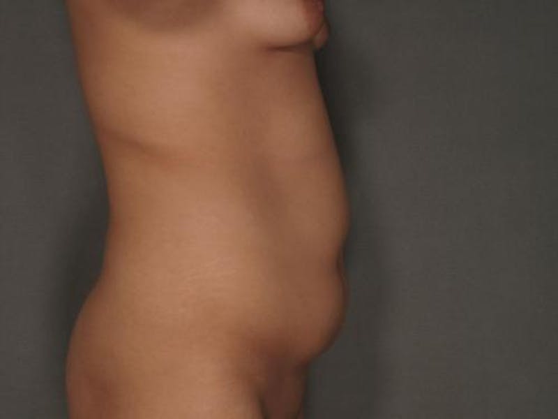 Tummy Tuck Before & After Gallery - Patient 12880255 - Image 5