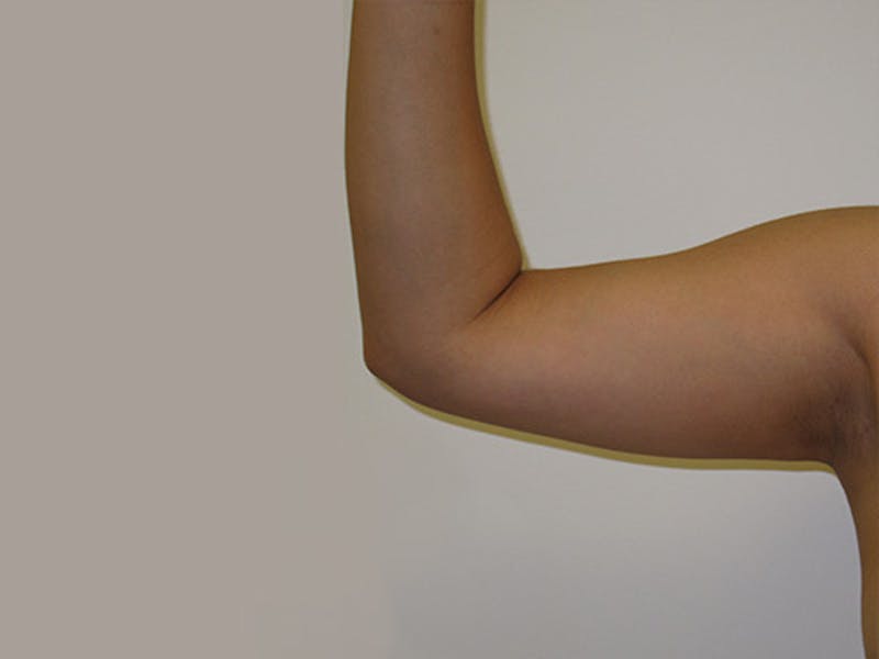 Liposuction Before & After Gallery - Patient 12880251 - Image 1