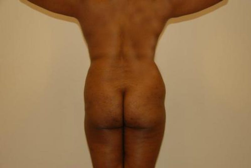 Brazilian Butt Lift Before & After Gallery - Patient 12880253 - Image 1