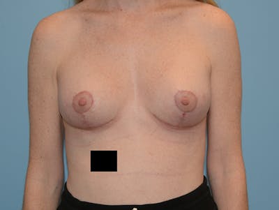 Breast Lift Before & After Gallery - Patient 12880259 - Image 2