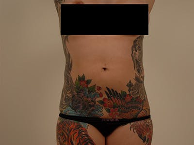 Liposuction Before & After Gallery - Patient 12880263 - Image 1