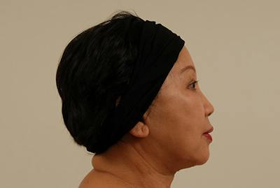 Facelift/Necklift Before & After Gallery - Patient 12880256 - Image 2