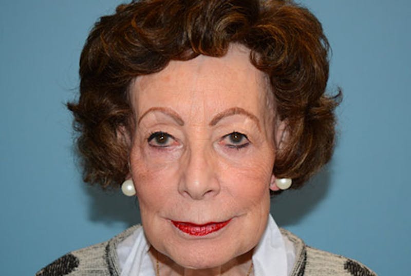 Blepharoplasty Before & After Gallery - Patient 12880260 - Image 1
