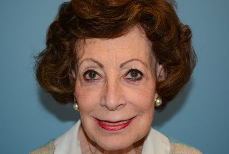 Blepharoplasty Before & After Gallery - Patient 12880260 - Image 2
